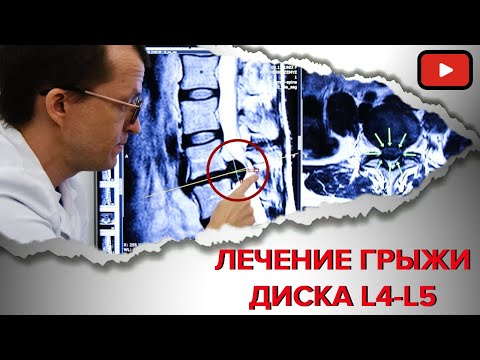 ВЫЛЕЧИЛИ ГРЫЖУ ДИСКА L4-L5