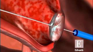 Edwards Sapien Transcatheter Heart Valve Animation