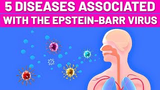 5 Diseases Associated With the Epstein–Barr Virus