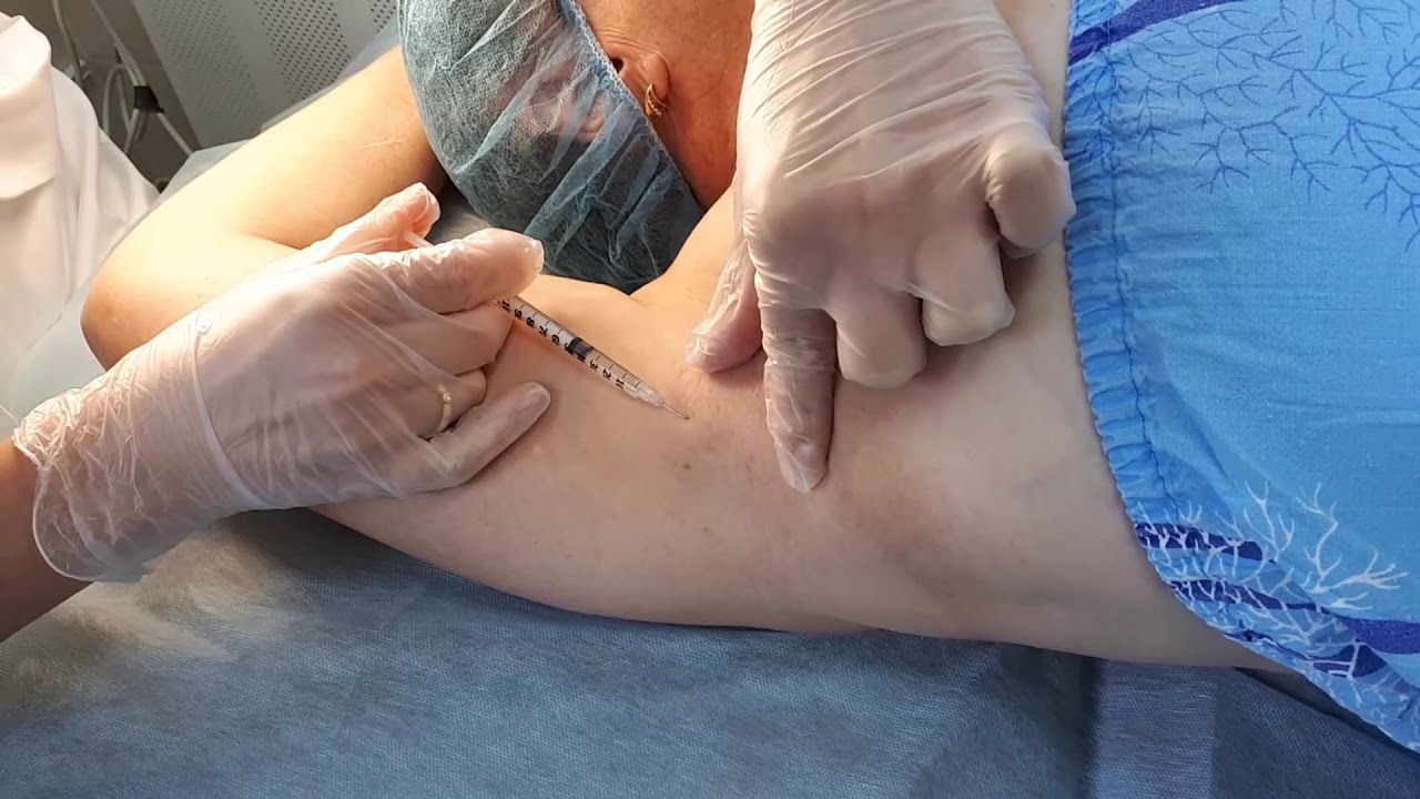 Электрокоагуляция папиллом в подмышечной области