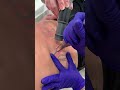 Удаление татуировки на аппарате More-Xel Dual Lumiere(Q-PTP)