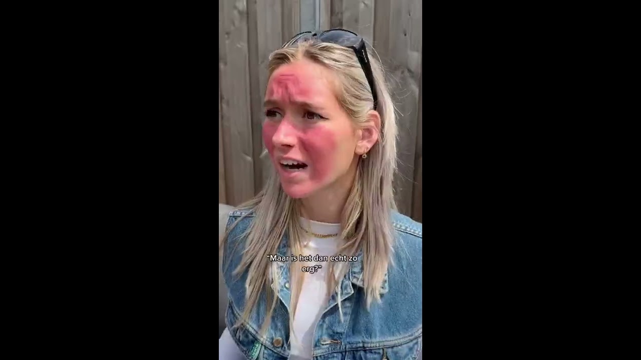 Maxime Haar Gezicht Is Volledig Verband 