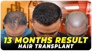 Hair Transplant Results | Best Cost & Best Hair Transplant Result