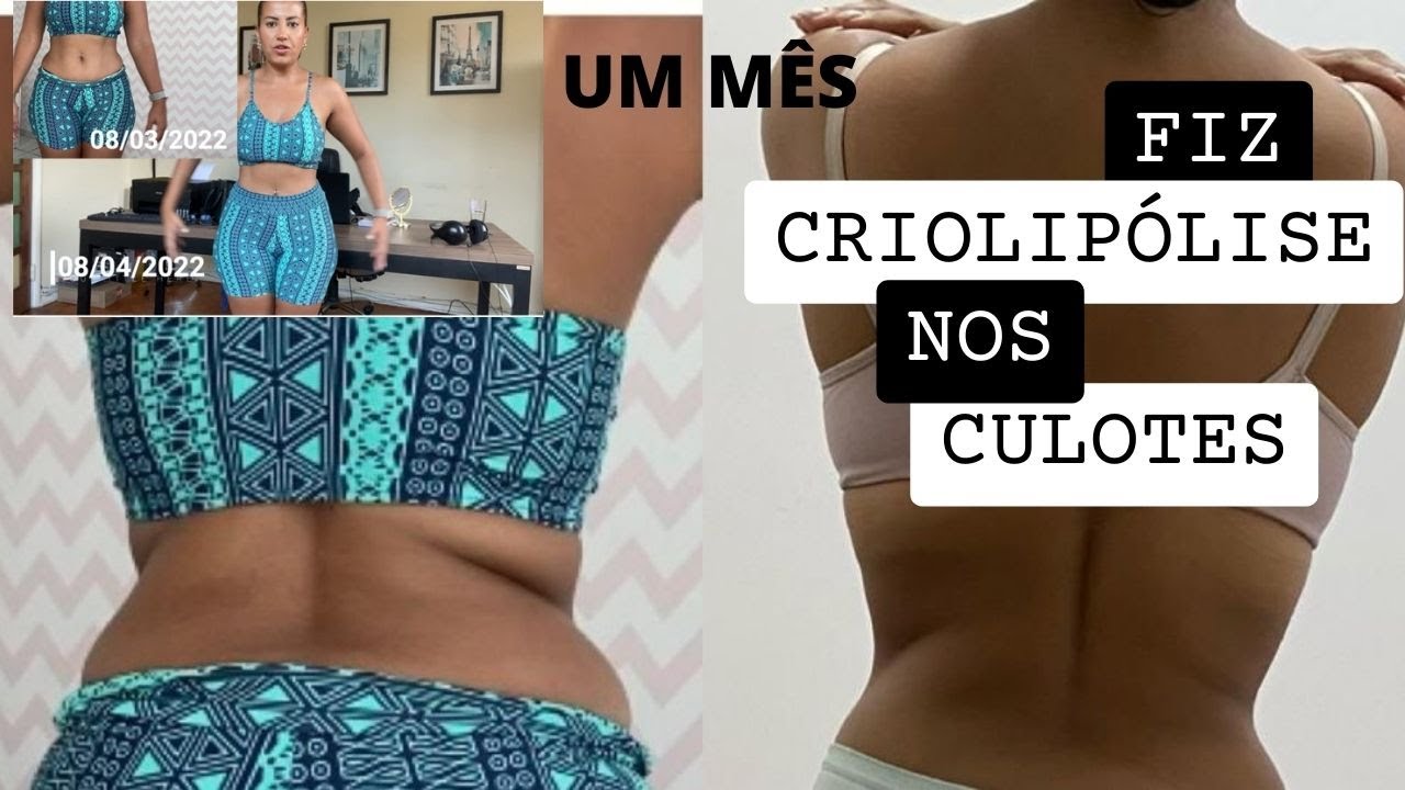 Resultado CRIOLIPÓLISE - Fiz nos culotes e no quadril | Mostrei tudo o ANTES e DEPOIS