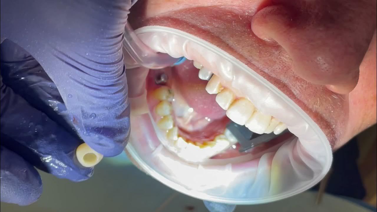 Digital Workflow Guided Implant Surgery with Immediate RODO Temporary