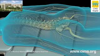 Lumbar Laminectomy - CIMS Hospital