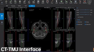CT TMJ Interface, Dental Cone Beam CT software Single function display -- LargeV SmartVPro