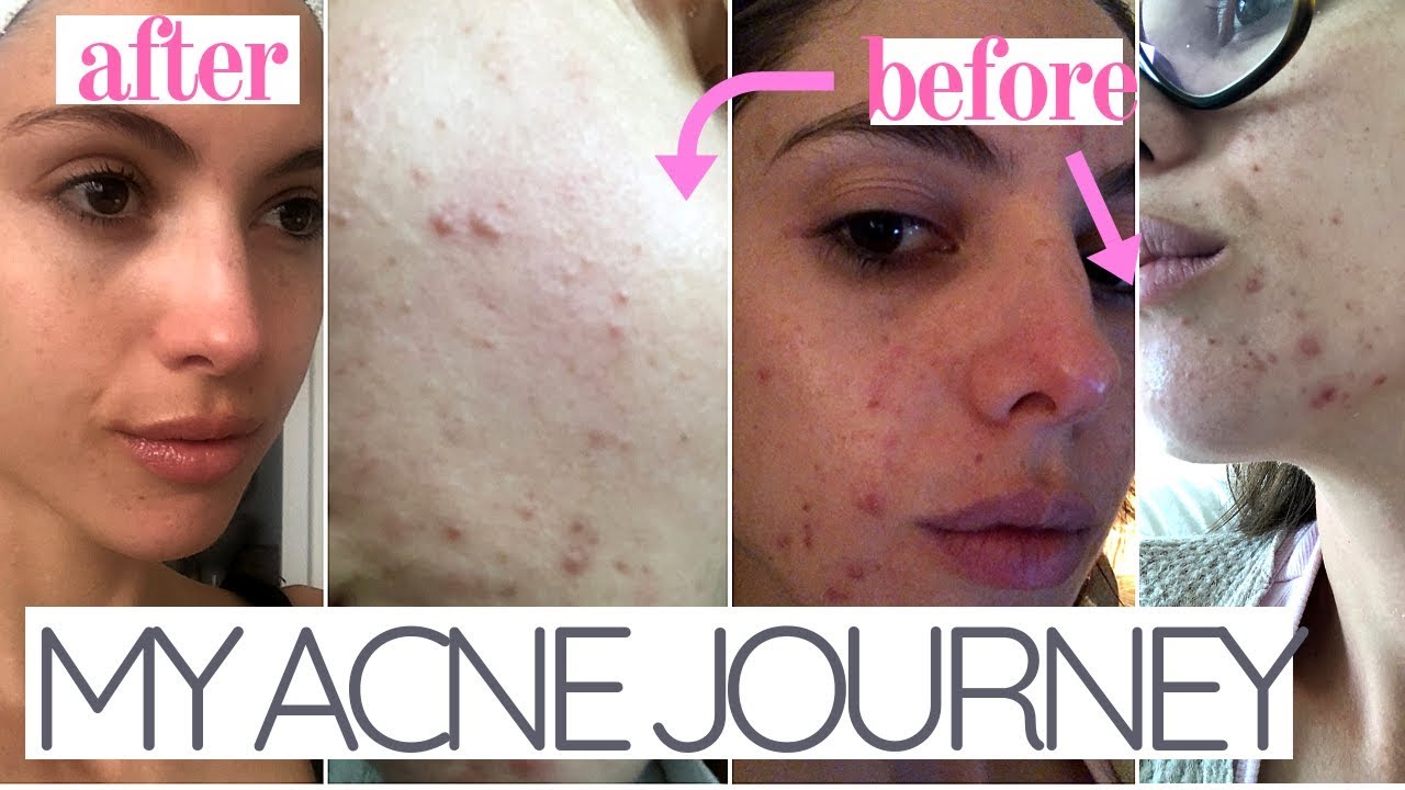 How I Cleared My Acne My Skin Journey Youtube
