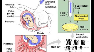 Amniocentesis vs Chorionic Villus Sampling