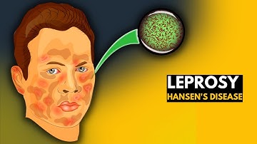 Leprosy (Hansen