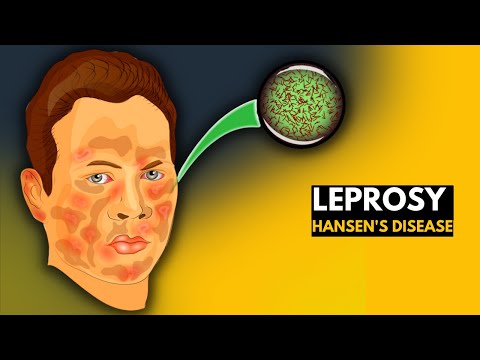 Leprosy (Hansen&rsquo;s disease): Everything You Need to Know