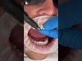 Composite Veneer Makeover ✨