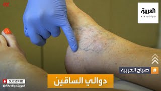 صباح العربية | كيف نتعامل مع دوالي الساقين؟