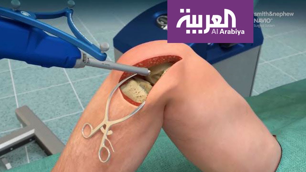 صباح العربية: روبوت يجري عمليات العظام في دبي