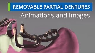 Removable Partial Dentures Animations & Images