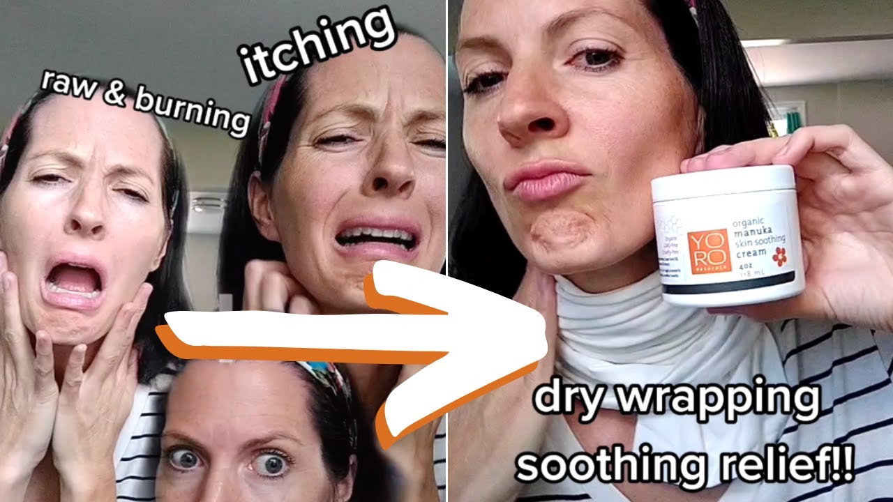 Do THIS for Eczema Relief!