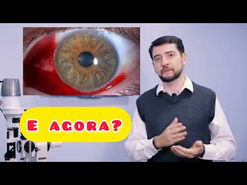 HEMORRAGIA NO OLHO