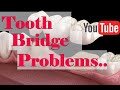 Best dental clinic in chennai  tooth bridge problems in tamil  senthil dental care sdc