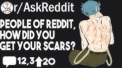 People of Reddit, How did you get your scars? - r/AskReddit