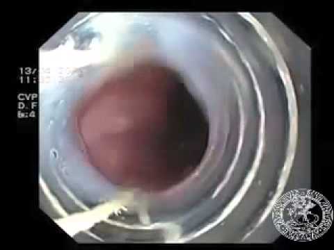 varicoză limbe inferioare video