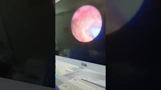 تفتيت حصى الحالب بالليزر Ureteric stone dusting with laser