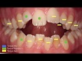 Mordida Abierta y Sonrisa Gingival Sin Cirugía