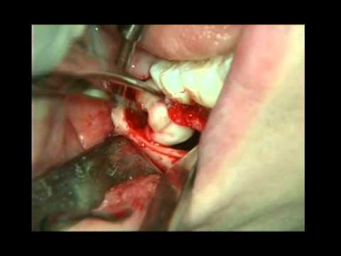 Follicular cyst in posterior mandible around impacted third molar - YouTube
