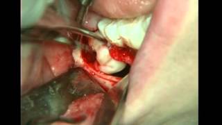 Follicular cyst in posterior mandible around impacted third molar