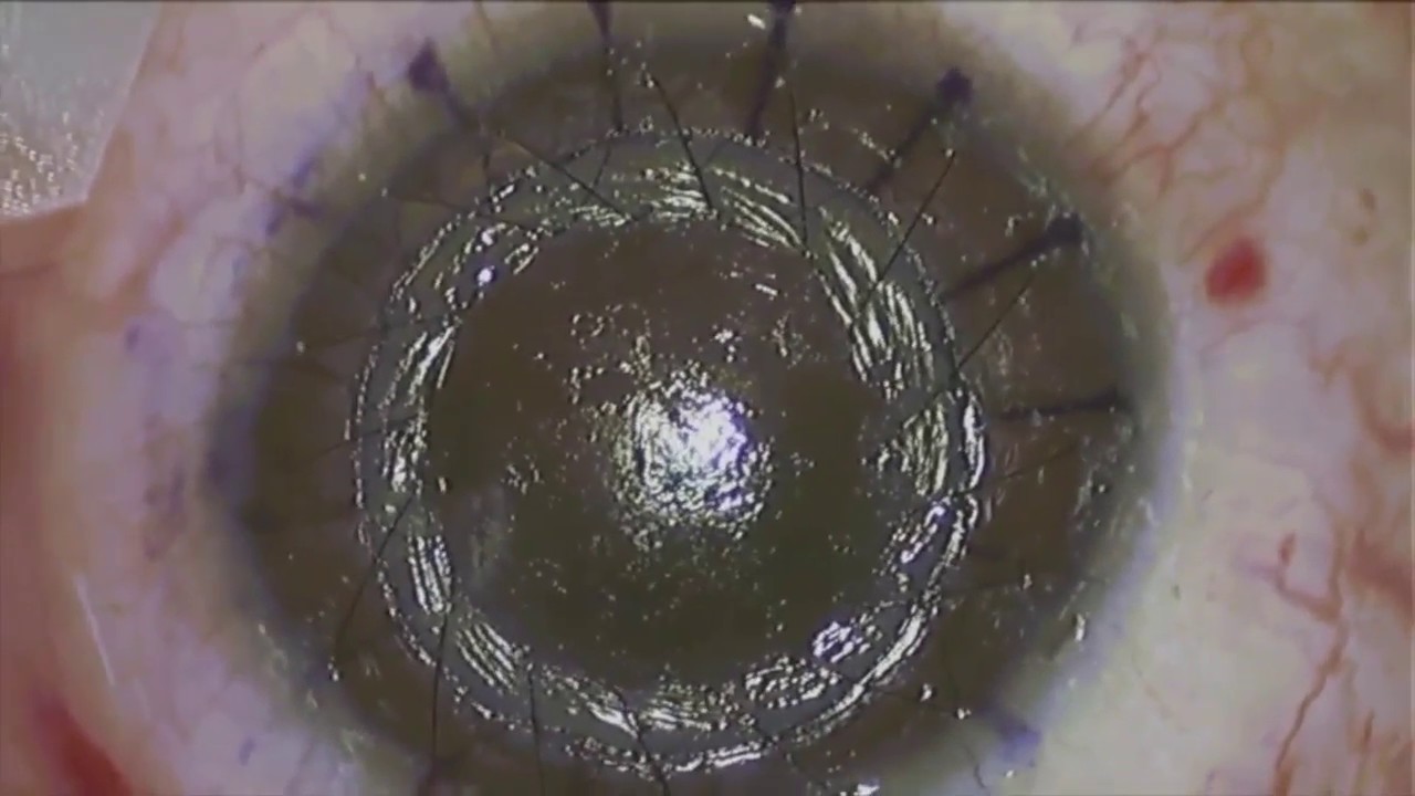 OCT guided DALK with FEMTO LDV Z8 by Prof. Schmidinger - YouTube