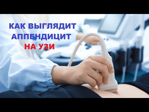 УЗИ аппендицита