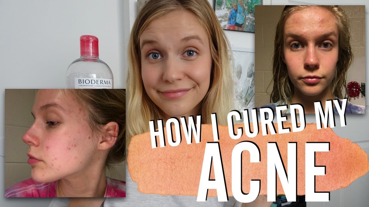 HOW I GOT RID OF MY ACNE // MY SKIN CARE