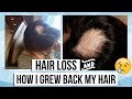 My Alopecia Areata Story (Hair Loss) + Products I used to grow my hair back!