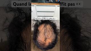 Première séance de tricopigmentation capillaire effet densité  après une greffe capillaire #rouen