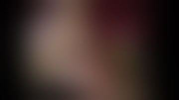 Robotic Cholecystectomy with FireFly