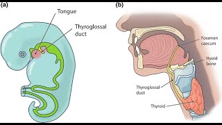 Thyroglossal duct fistula \/ Thyroglossal Cyst Fistula