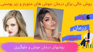 6 روش عالی برای درمان جوش های متورم و زیرپوستی ، درمان جوش صورت