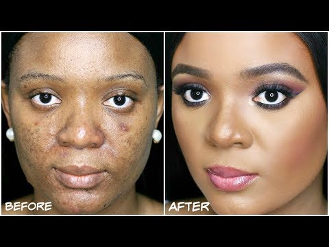 HOW TO COVER ACNE, DARKSPOTS & HYPERPIGMENTATION - MY ACNE COVERAGE FOUNDATION ROUTINE | OMABELLETV