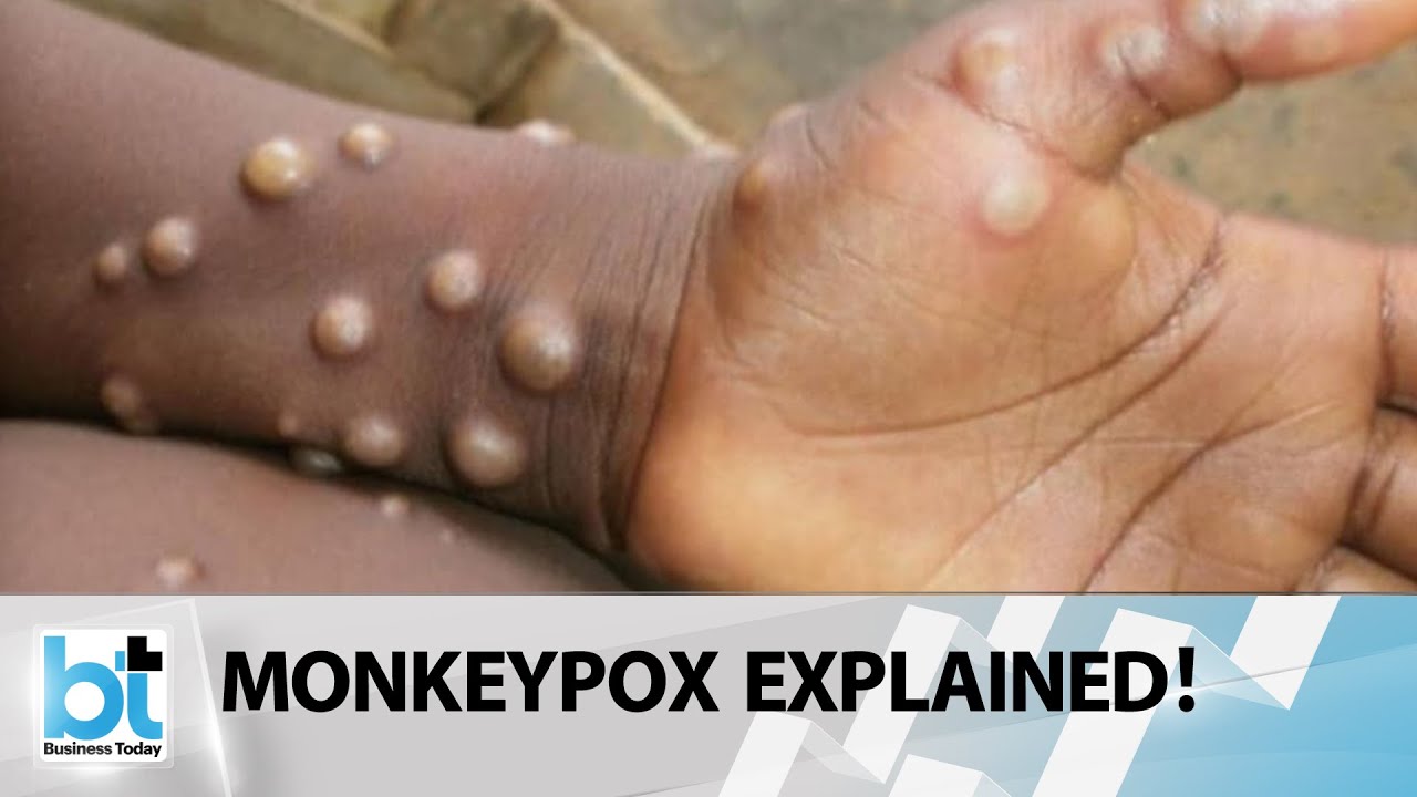 What Is Monkeypox Virus?