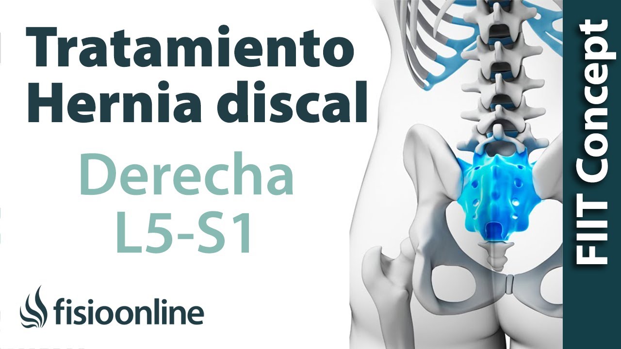 Artesano Dureza arrepentirse Tratamiento de la hernia discal L5 y S1 derecha o quinta lumbar y sacro -  YouTube