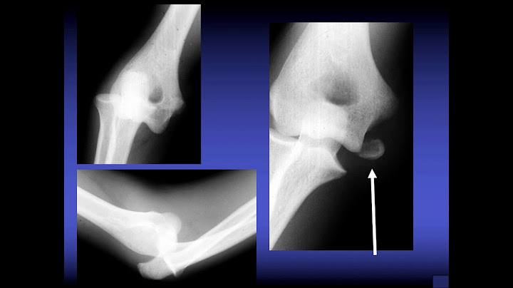 683 01 Elbow - Why does my Arm Hurt: From Little Leaguers to Golden Sneakers Case-Based