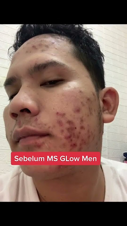 TESTIMONI MS GLOW MEN UNTUK WAJAH BERJERAWAT !!! #msglow #shorts #testimonimsglow #msglowmen
