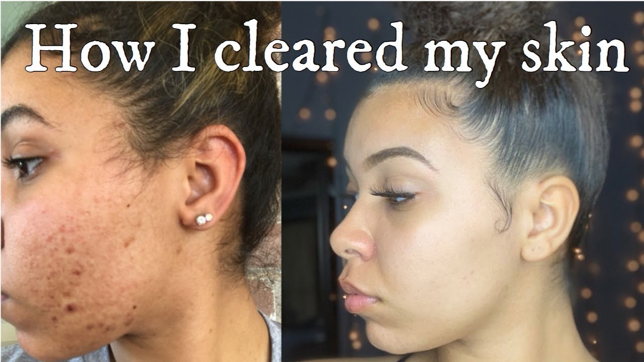 HOW I CLEARED MY SKIN Skin Care Routine Curlytashh YouTube