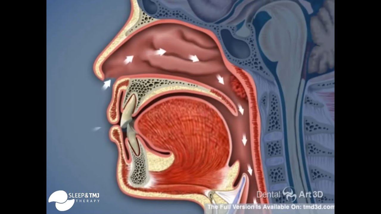 Airway Issues & TMJ YouTube