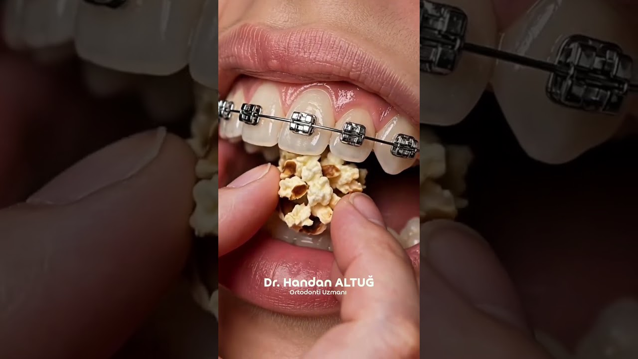 🦷 “Diş teli varken neler yenmemeli ve içilmemeli”Diş teli tedavisinde braketlerin ve tellerin z