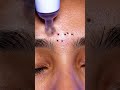 Between Eyebrows Blackhead Vacuum ASMR #satisfying #blackheadcaique #skincare #asmr #blackheads