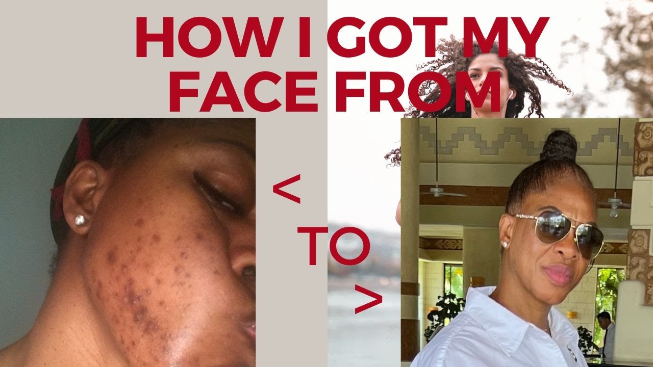 MY SKIN CARE ROUTINE HOW I CLEAR MY SKIN FROM BLEMISHES YouTube