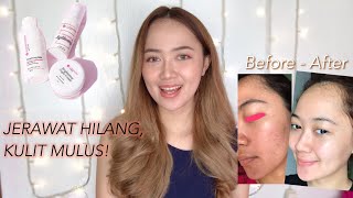 REVIEW AIRINBEAUTYCARE SELAMA 4 BULAN PEMAKAIAN - BYE JERAWAT!💫