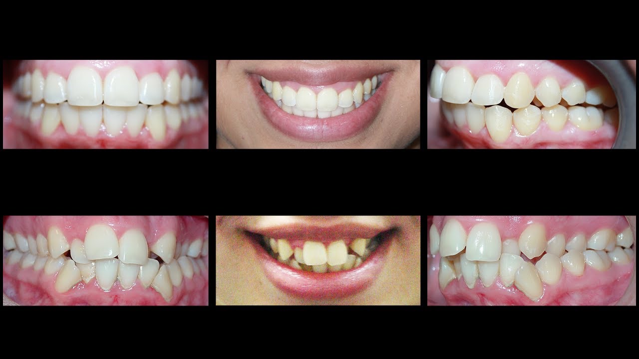 Invisalign for Treating Crowding Teeth and Crossbite at ...