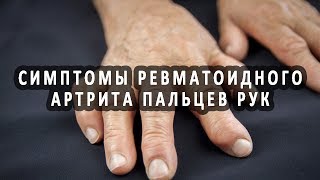 Первые проявления ревматоидного артрита пальцев рук Первые проявления ревматоидного артрита пальцев рук