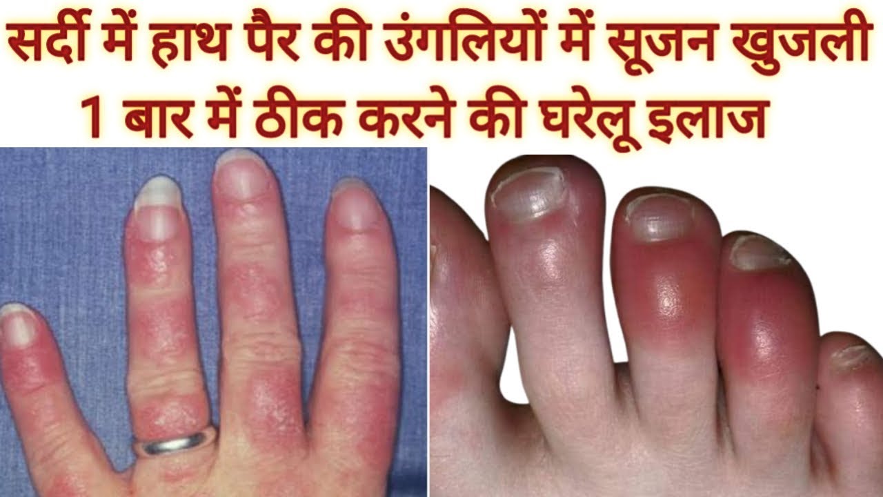 सर्दी में हाथ पैर की उंगलियों में सूजन और खुजली ठीक करने की घरेलू इलाज
